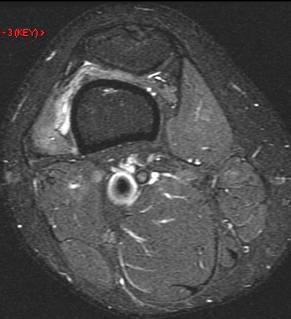 Figure 4 for case Patellar tendon re-tear